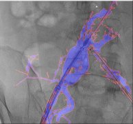“AngiSight”软件表示 
